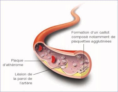 Quelles sont les causes de l&#8217;athérosclérose ?